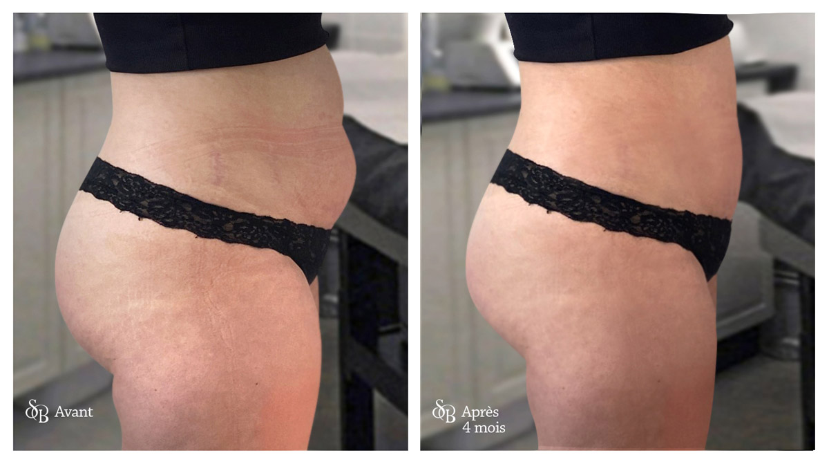 avant après perte de poids localisé