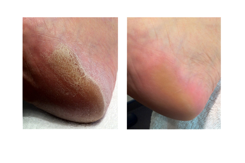 pieds avant après traitement calluspeeling